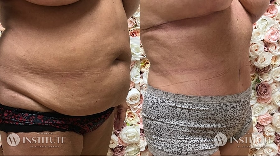 Mommy Makeover Before & After