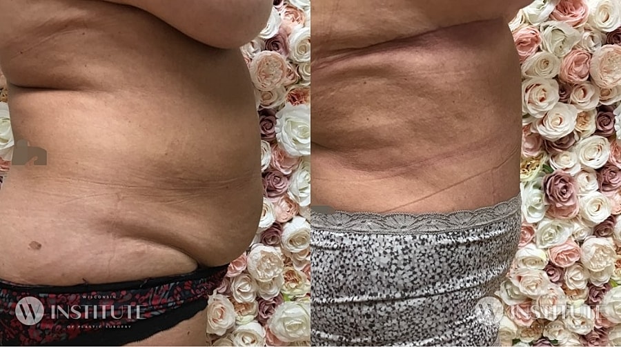 Mommy Makeover Before & After