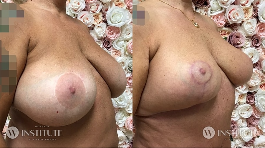 Mommy Makeover Before & After