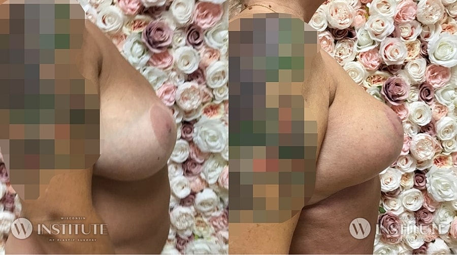 Mommy Makeover Before & After