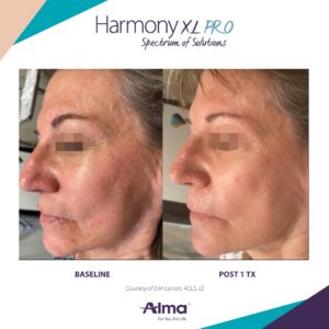 Alma® Rosacea Treatment Using Harmony XL PRO Before and After