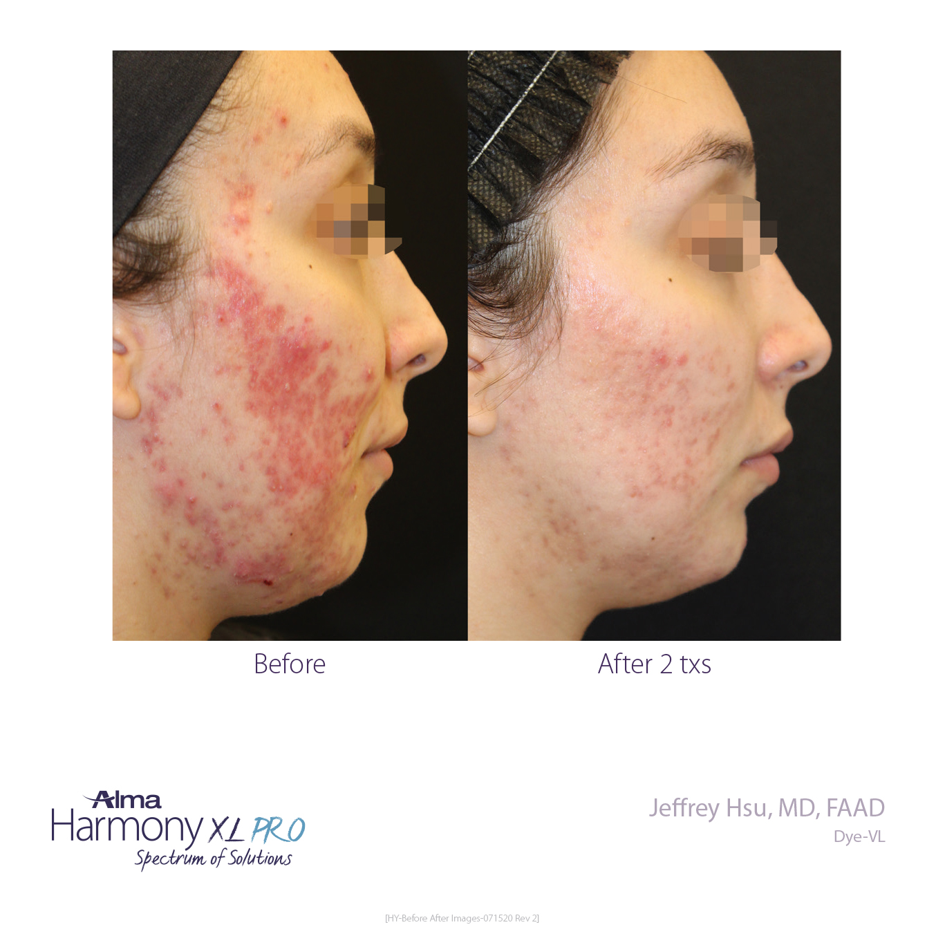 Dye-VL Acne Before and After with Harmony XL PRO