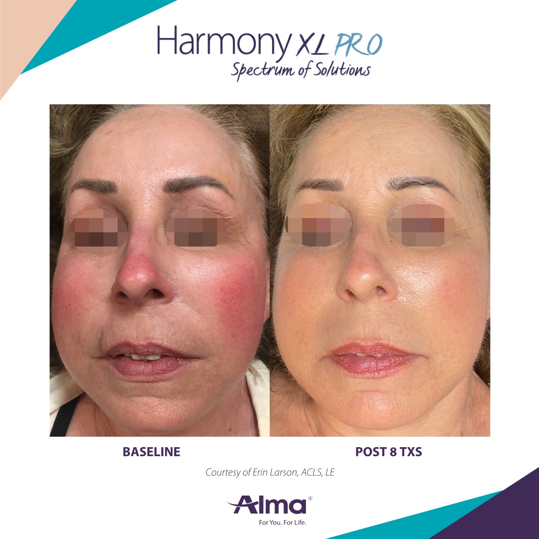 Rosecea Treatment Before and After - Harmony XL Pro