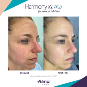 Alma® Rosacea Treatment Using Harmony XL PRO Before and After 2